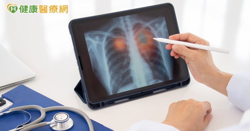 晚期肺癌治療現曙光 最新健保給付標靶藥物不限腦轉移