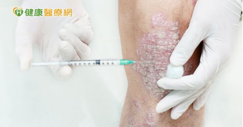 乾癬生物製劑平行轉換條款　幫助病患解決難治部位的困擾