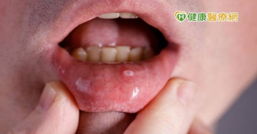 易罹口腔癌「前三大行業」曝！　台灣檳癌防制聯盟推動無檳工地