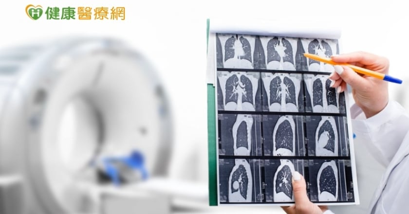 追蹤肺結節無異常 低劑量電腦斷層揪腫瘤