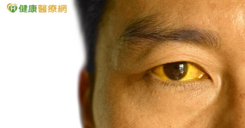 75歲退休教授突全身發黃！ 竟是B肝急性肝衰竭險喪命