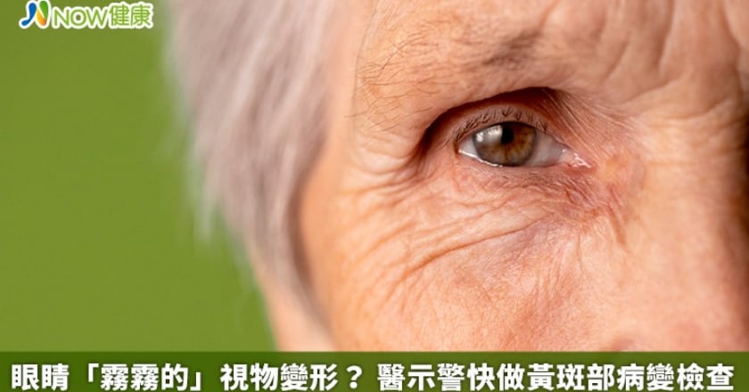 眼睛「霧霧的」視物變形? 醫示警快做黃斑部病變檢查