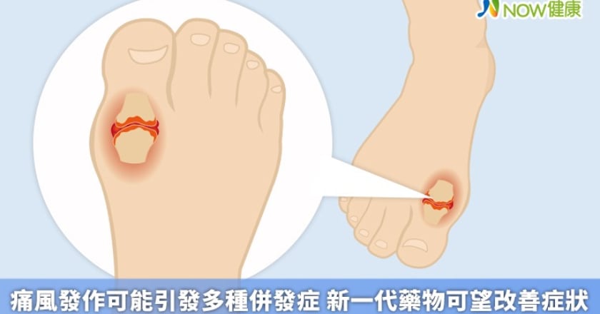 痛風發作可能引發多種併發症 新一代藥物可望改善症狀