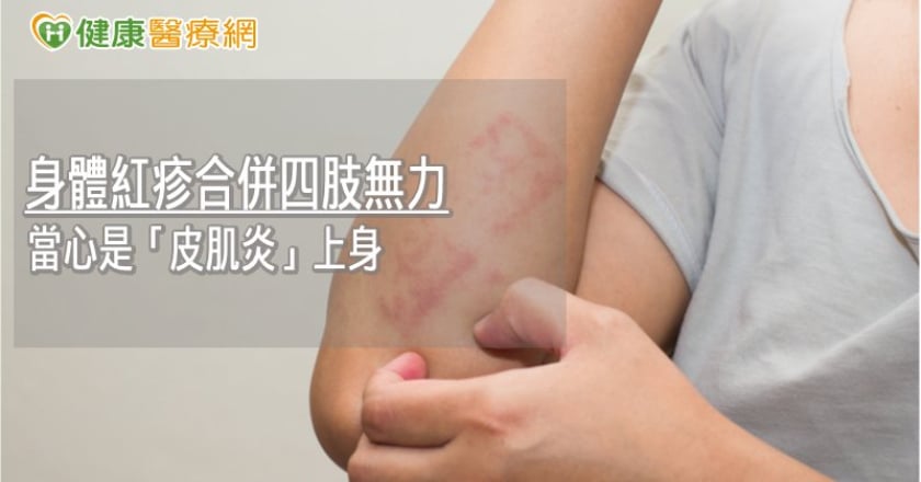 身體紅疹合併四肢無力　當心是「皮肌炎」上身