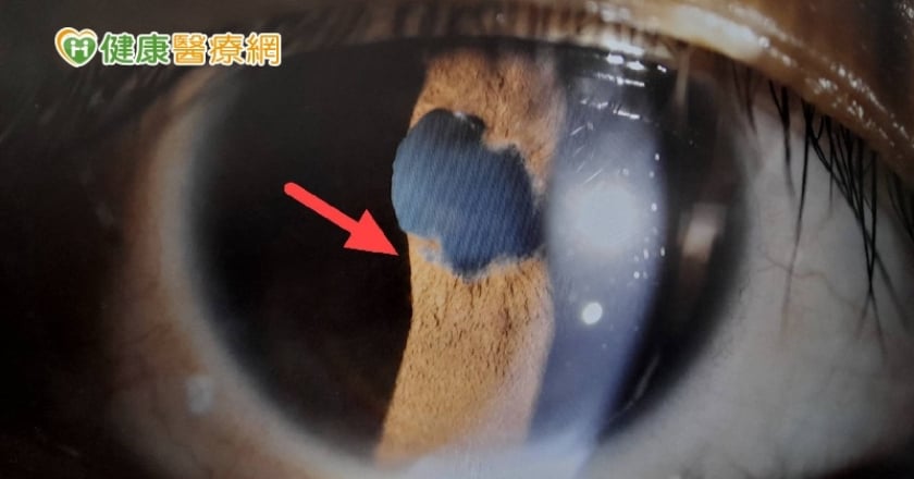 「眼紅＋視力模糊」就醫不見效？　恐是自體免疫惹禍