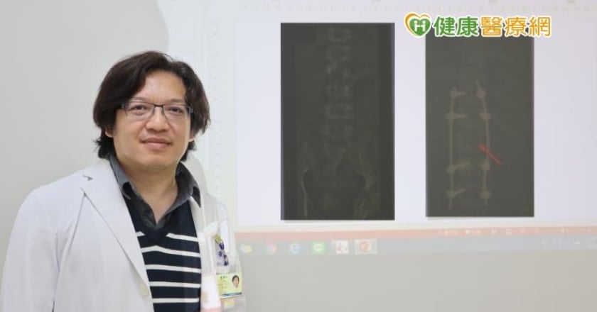 男墜下水道OHCA　葉克膜搶回一命　化解癱瘓危機