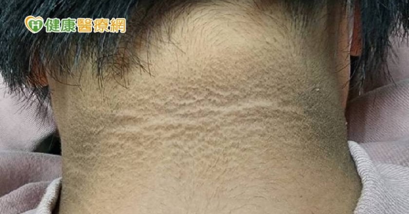 小時候胖要注意!國中生肥胖出現「黑色頸紋」 嚴重恐演變成糖尿病
