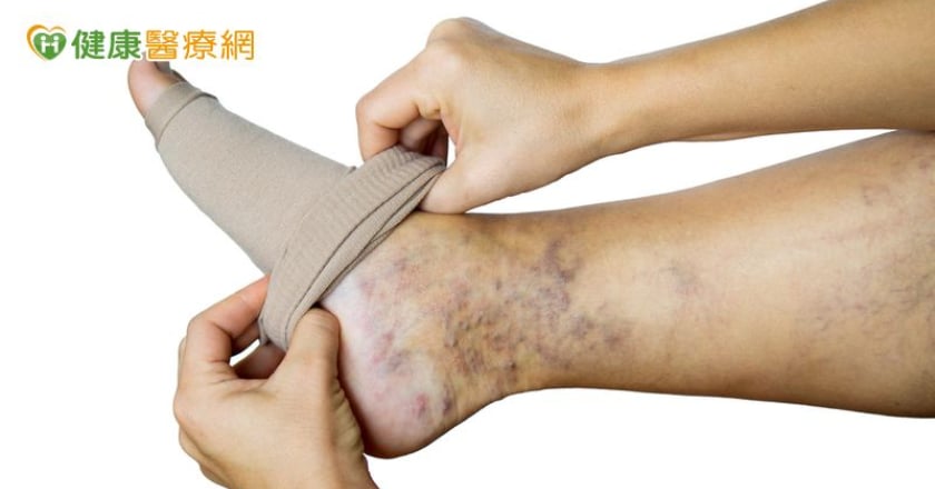 靜脈曲張穿壓力襪過敏沒效？ 「這1微創手術」助她找回生活品質