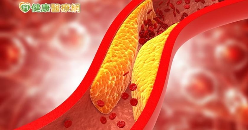 膽固醇過高就不健康嗎？醫：「低密度脂蛋白」數值才是關鍵！