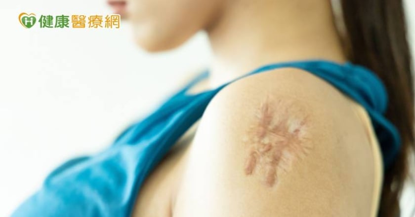 手臂「蟹足腫」困擾20年 「1治療」方式解決心頭大患