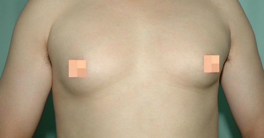 他狂健身變「大咪咪」 男性女乳症作祟