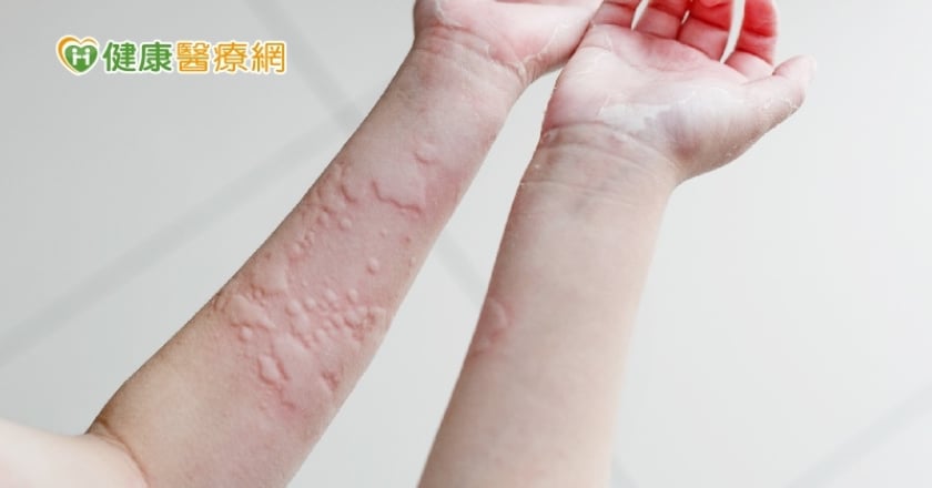 免疫力太強也會得病！　「這類患者」當心症狀惡化