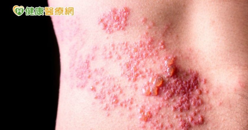 流感季來了! 口罩可防「流感、肺炎」　但「罩」不住「皮蛇」