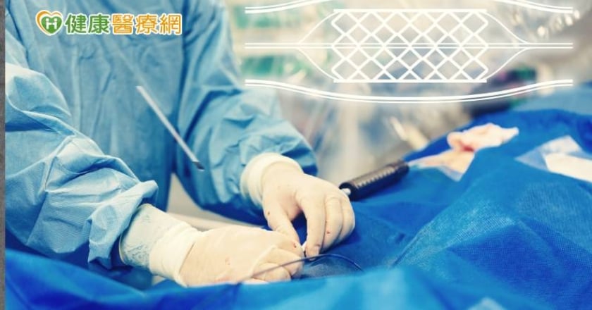 心血管狹窄一定要放支架嗎？ 精準檢測免除不必要的風險