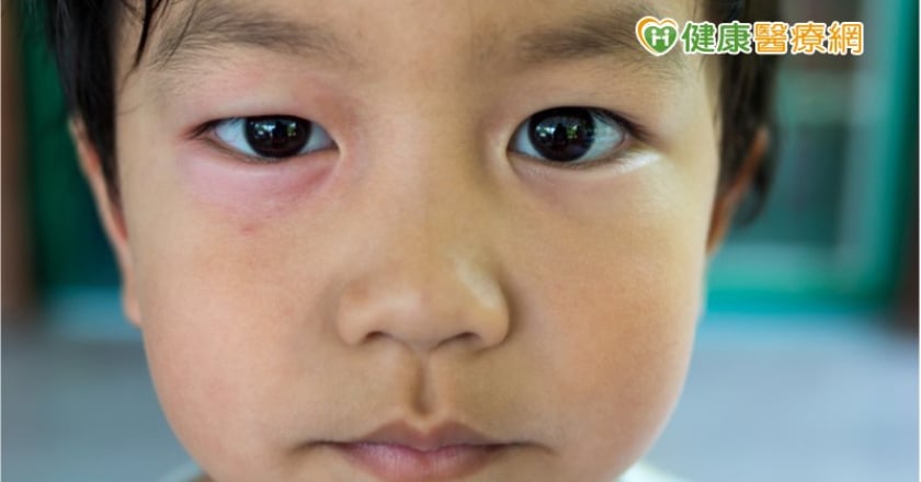 孩子眼皮腫　當心「腎病症侯群」找上門！