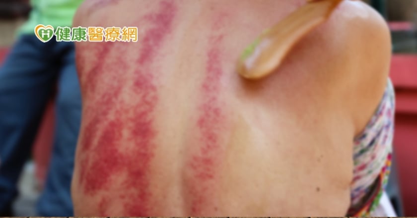 刮痧力道如何拿捏　刮痧顏色越深效果越好嗎？