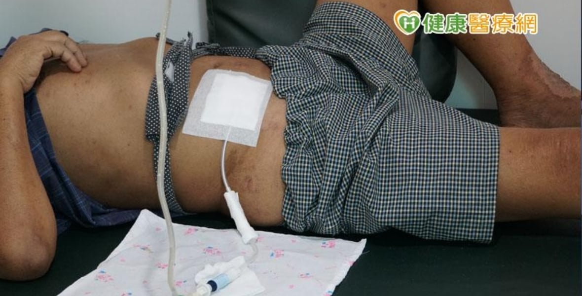 【洗腎專題】血液透析、腹膜透析人數比例懸殊　醫籲從全人層面審慎考量