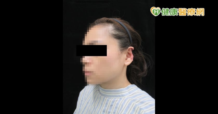 耳朵被人咬掉　整外醫師3次手術斷耳再造