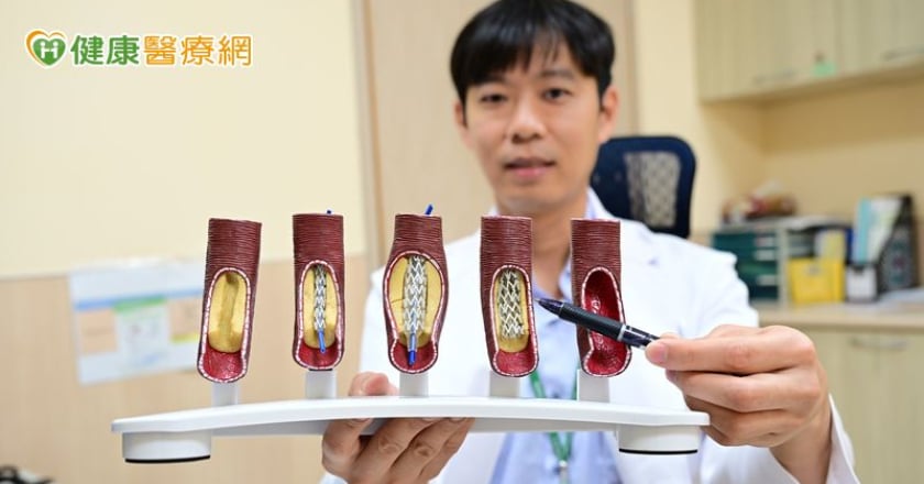 婦反覆胸痛心電圖、Ｘ光找不出異狀 「1檢查」秒見右冠狀動脈99%阻塞