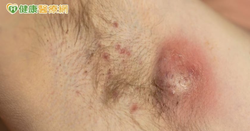 卡車司機屁股流膿，竟是化膿性汗腺炎！生物製劑治療新利器盼納健保
