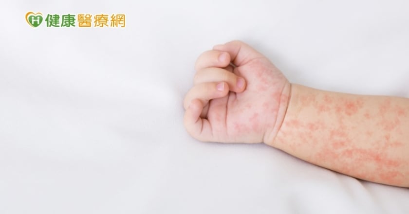 全球麻疹疫情升溫!歐洲病例暴增45倍 應接種1疫苗過年出國注意「這些」