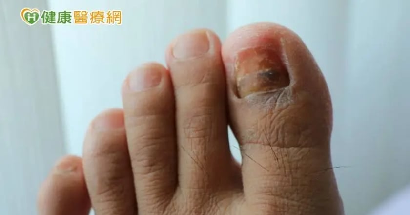 他工作長時間穿雨鞋甲溝炎反覆發作 髮廊修剪竟釀蜂窩性組織炎