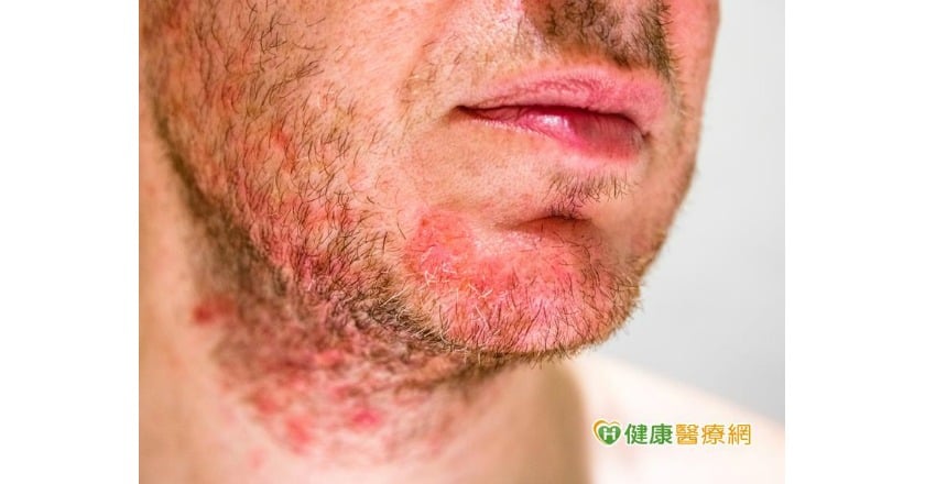 帶狀疱疹易復發 聰明用藥是關鍵