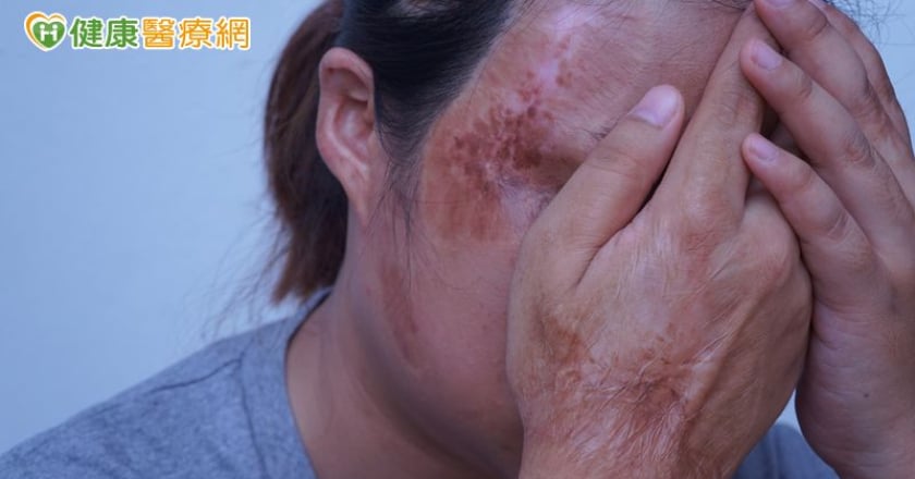 調查：逾5成顏損者面試曾遭不友善對待 陽光推「職場臉部平權行動指引」