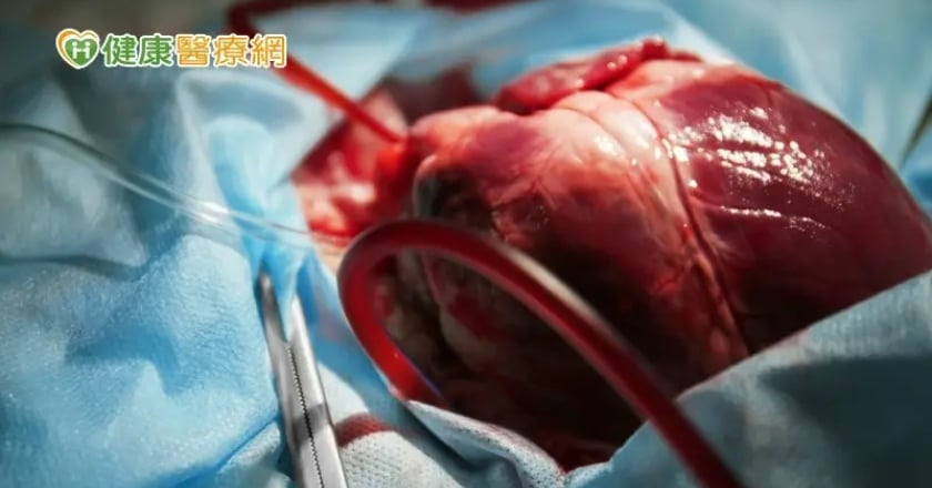 全球第2例豬心移植! 58歲患者術後狀況佳、密切觀察中