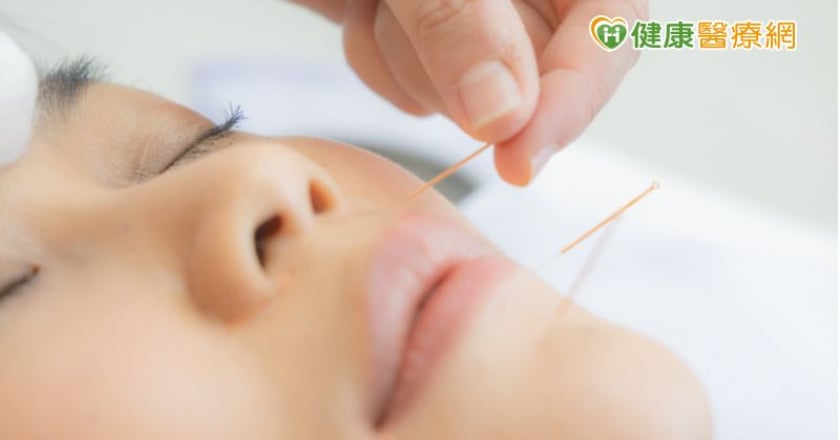 中醫微細針灸減輕雙下巴 改善睡眠呼吸中止症