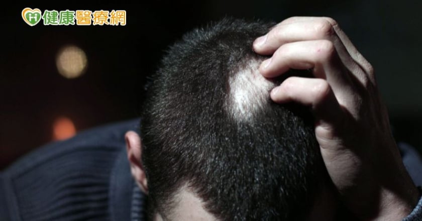 男性也能有女性雄性禿！！ 雄性禿治療診斷大解密