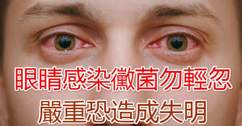 眼睛感染黴菌勿輕忽 嚴重恐造成失明
