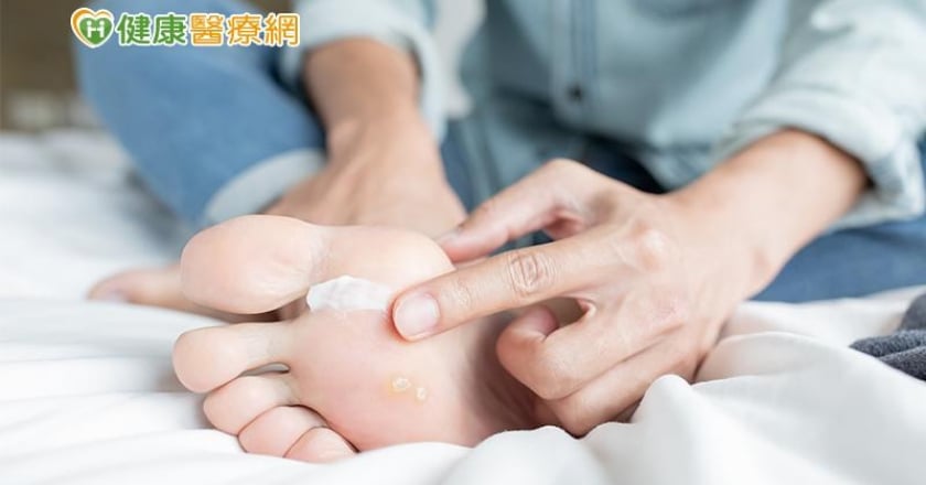 梅雨讓你「香港腳」復發了嗎？醫師：康復後繼續擦藥1～2週