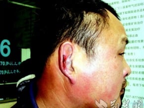 垃圾車司機值勤遭毆打至耳聾