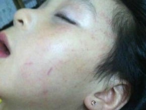 幼師虐童事件再現 溫州一6歲孩子被重摑致淤青