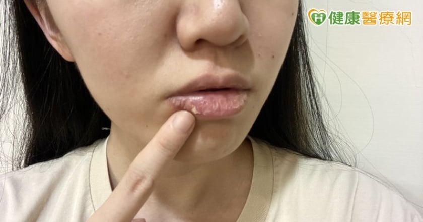 撕嘴皮撕到流血仍停不下來？醫揭可能與大腦1機制有關 當心是情緒警訊