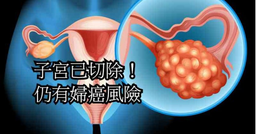 就算子宮已切除！　仍有子宮頸癌風險