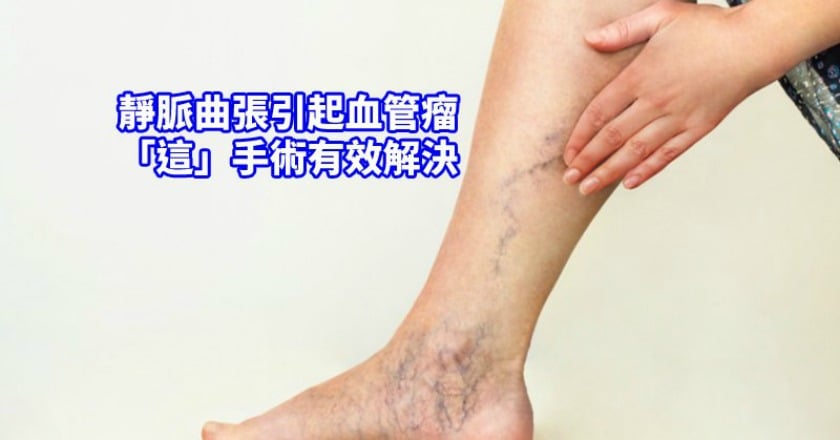 長如雞蛋大小肉瘤，連站立都疼痛　靜脈膠水救了她
