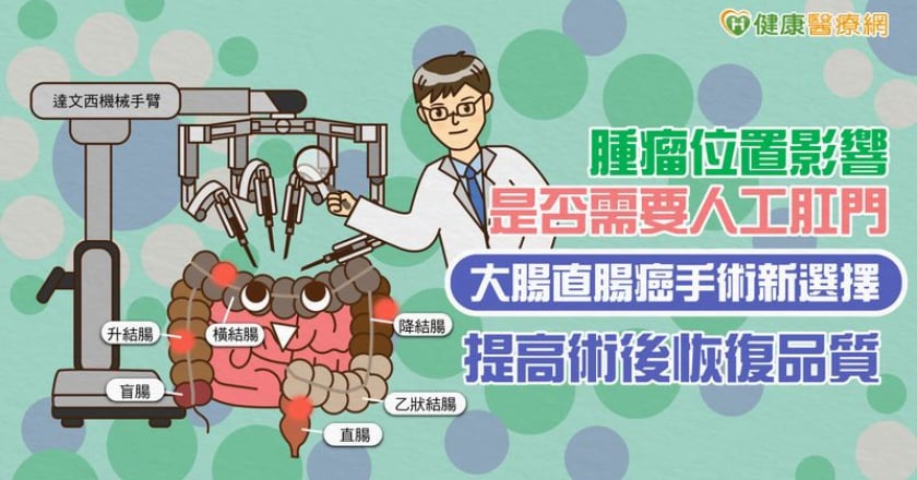 腫瘤位置影響是否需要人工肛門 大腸直腸癌手術新選擇 提高術後恢復品質