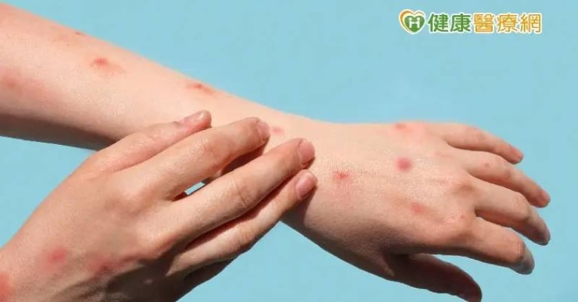 剛果M痘出現新的Ib分支病毒株！人際傳播風險更高 3類人應盡速接種疫苗