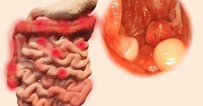 豬哥亮癌末病逝 你該知道的大腸癌防治