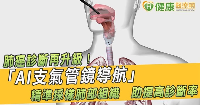 肺癌診斷再升級！「AI支氣管鏡導航」精準採樣肺部組織 助提高診斷率