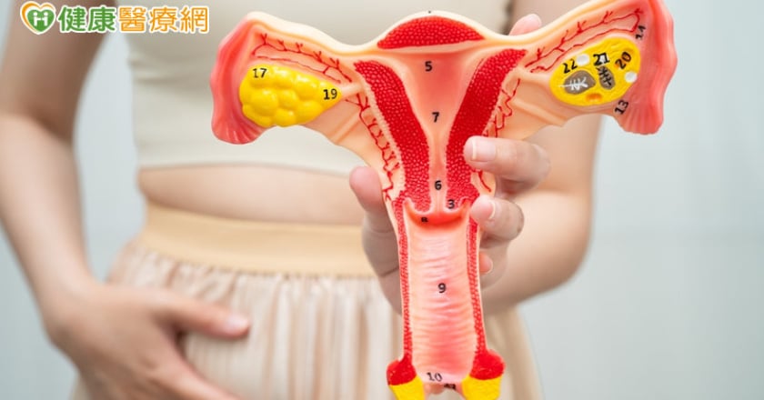 女性常見「多囊」改名了！PCOS更名PMOS 醫揭「P、M、O各代表什麼」