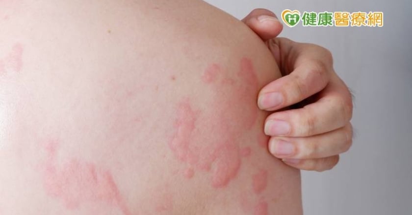 男子服感冒藥全身搔癢、冒皮疹 醫揭「1原因」惹禍:還可能致命