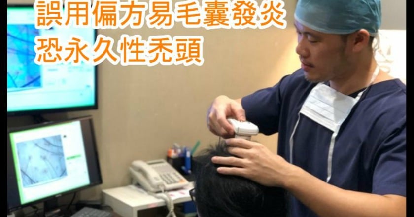 誤用偏方易毛囊發炎　恐永久性禿頭