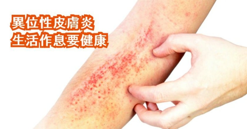 異位性皮膚炎生活不正常　小心療效打折扣