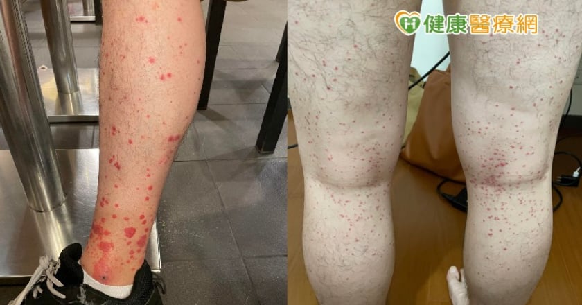 27歲男打BNT下肢驚見密麻血點　醫：過敏性紫斑症
