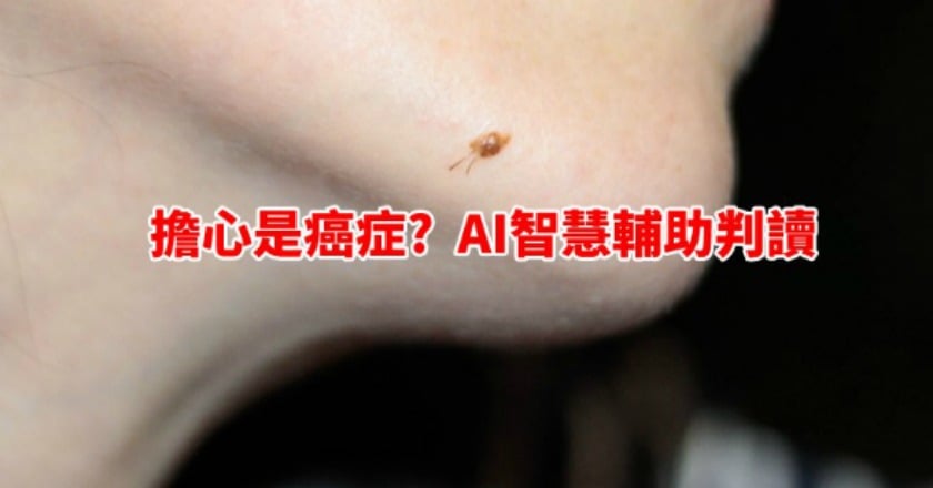 長痣、斑點，擔心是癌?　AI智慧輔助判讀