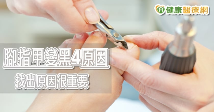 腳指甲變黑別急著拔　醫師揭指甲變黑4原因