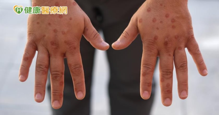變種M痘Ib型病毒常用檢驗法恐誤判！ 新PCR檢驗法上線加速檢驗Ib型